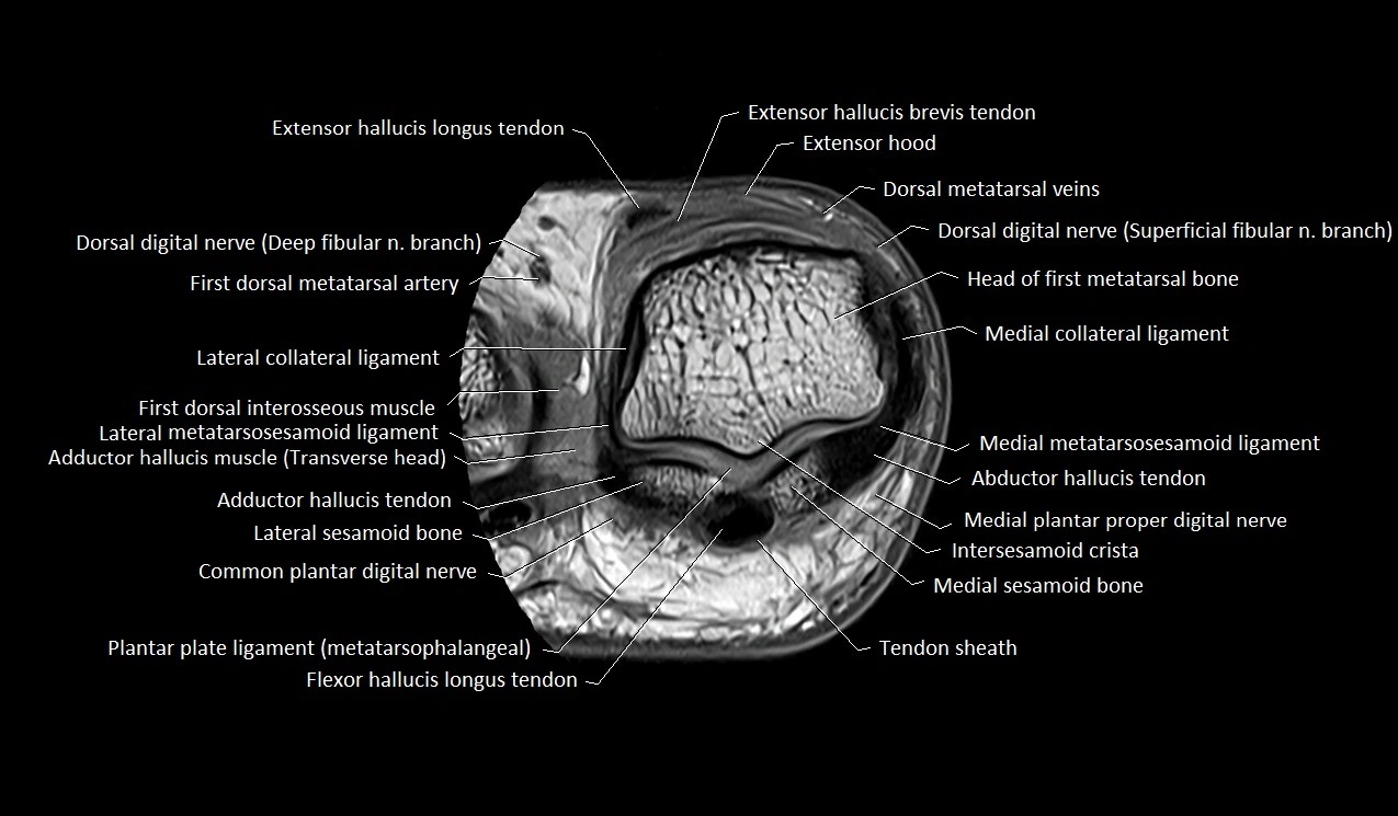 Great toe (hallux) axial microanatomy 3T MRI image 27.webp